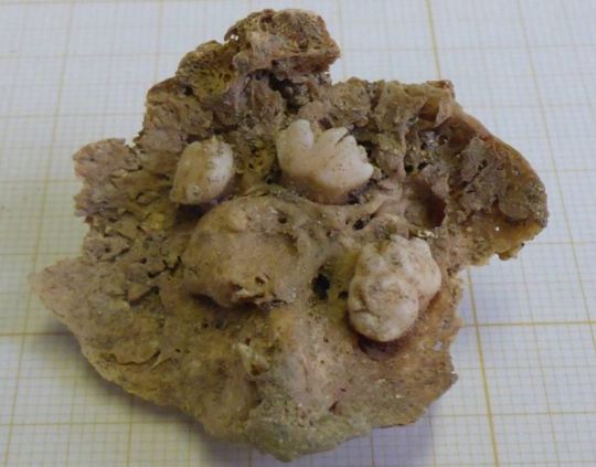 A Tumor with Teeth Discovered in Gothic Graveyard
