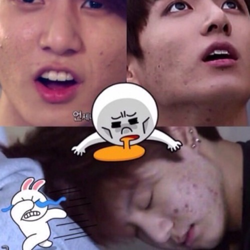 Kpop Idol With Chronic Acne Is There Any Cure Allkpop Forums