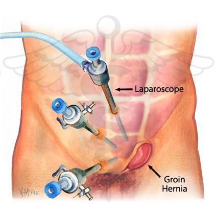 What can you expect after inguinal hernia surgery?