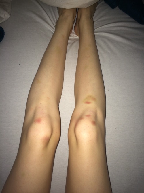 Bruised Leg 67