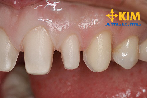 Mài răng có đau không, có tác động sức khỏe không?